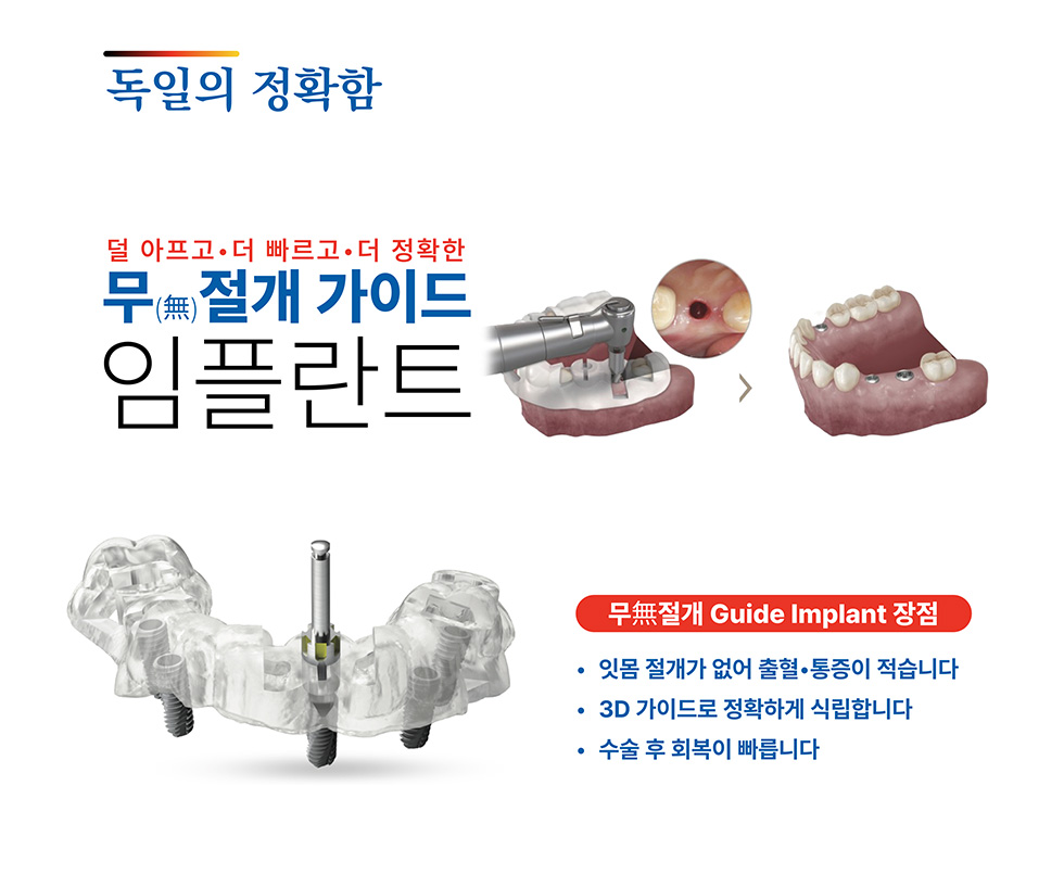 무절개 임플란트