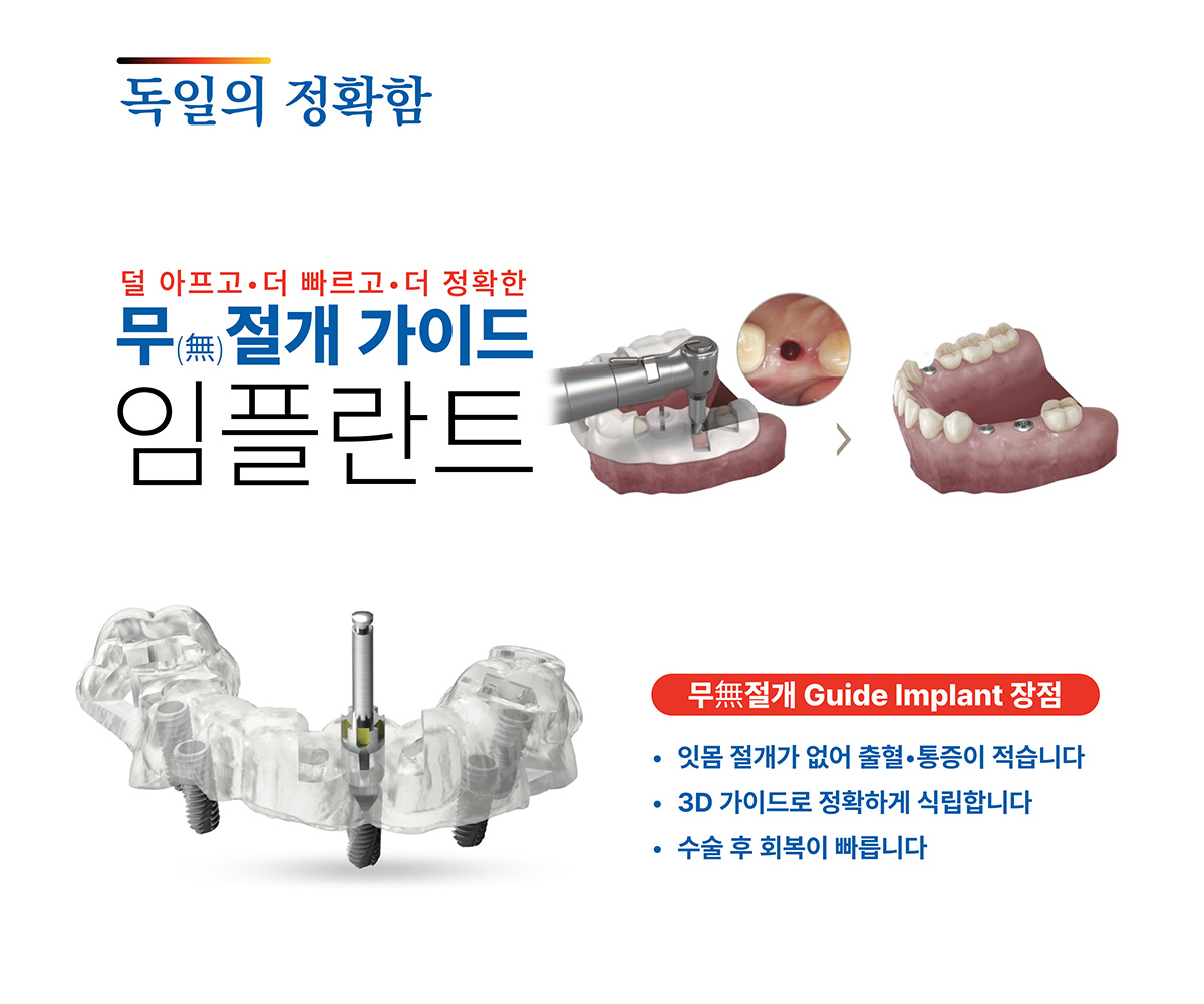 무절개 임플란트